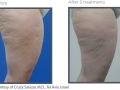 Cellulite 2