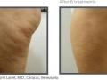 Cellulite 3