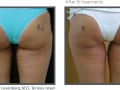 cellulite 1