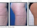 cellulite 4