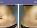 Skin Tightening