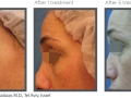 Wrinkle 10