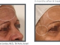 Wrinkle 3