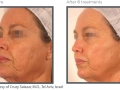 Wrinkle 7