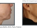 Wrinkle 9